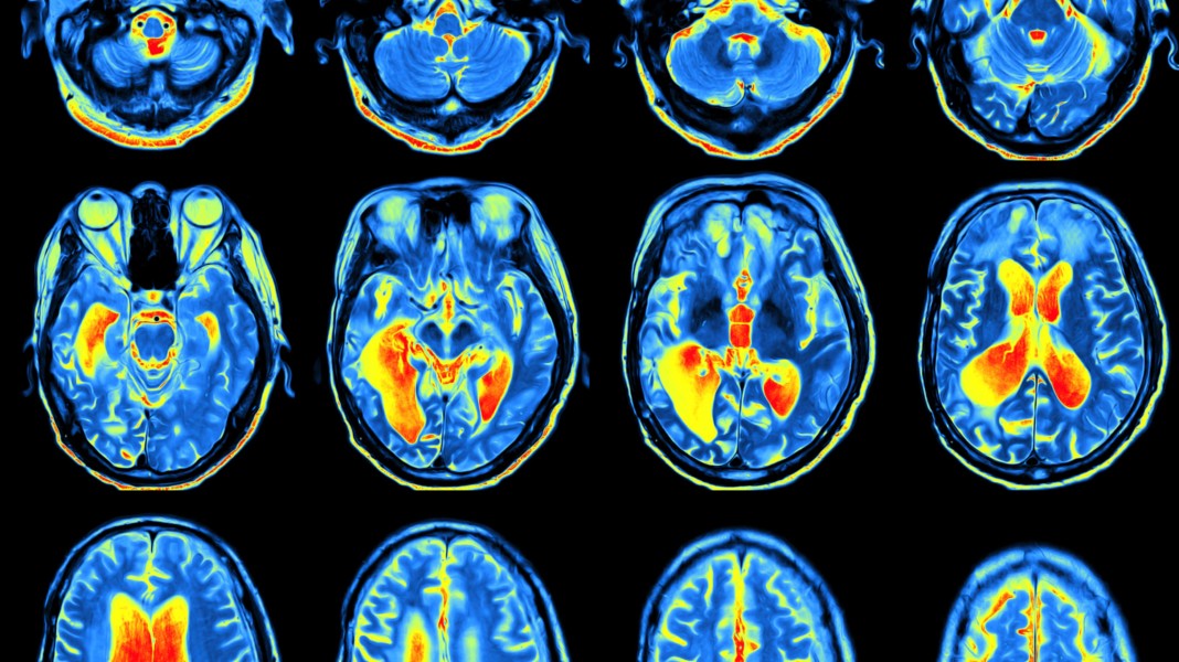 MRI hjerne nevrovitenskap
